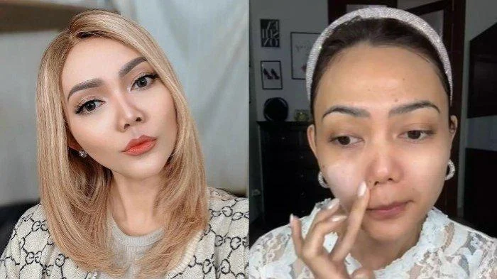 Rina Nose Akhirnya Ungkap Alasan 10 Tahun Menunda Operasi Hidung: Dari 'Trademark' hingga Pertimbangan Etis