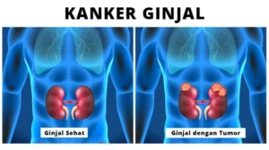 Waspada! 7 Komplikasi Mematikan Kanker Ginjal yang Harus Anda Ketahui Sekarang
