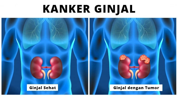 Waspada! 7 Komplikasi Mematikan Kanker Ginjal yang Harus Anda Ketahui Sekarang
